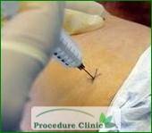 soft tissue injection